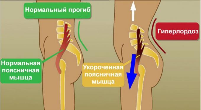 desdobramento: psoas