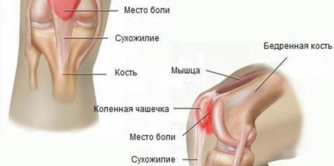 Por ferir seus joelhos: Síndrome da dor femoropatelar