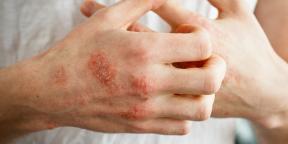 O que é eczema, por que aparece e como tratá-lo