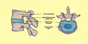 Onde é que a hérnia da coluna vertebral e o que fazer