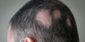 Alopecia: por que você está perdendo cabelo e como tratá-lo
