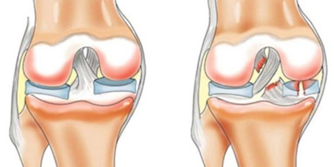 Por ferir seus joelhos: ligamento cruzado anterior ruptura