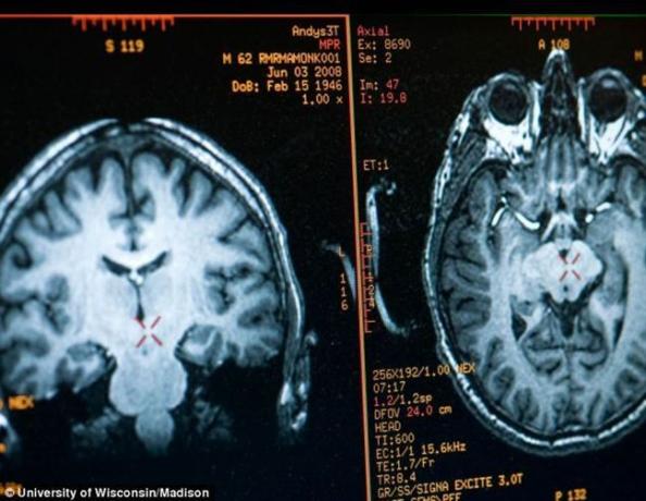 imagem do cérebro Mathieu Ricard obtida por MRI
