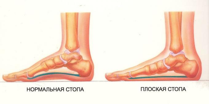 exercícios para os pés planos: pé normal e plana