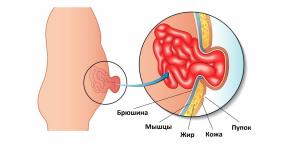 De onde vem uma hérnia umbilical e como tratá-la