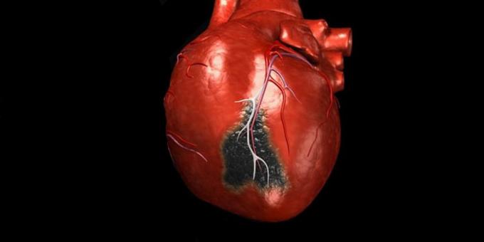 Os sintomas de um ataque cardíaco, para o qual você precisa chamar uma ambulância