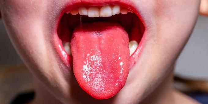 Sintomas de escarlatina: língua de morango