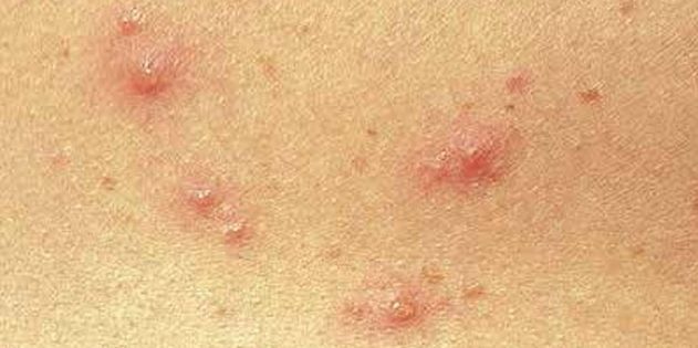 Os sintomas da varicela em crianças e adultos: Muitas vezes, a pele imediatamente aparecem pequenos pontos vermelhos