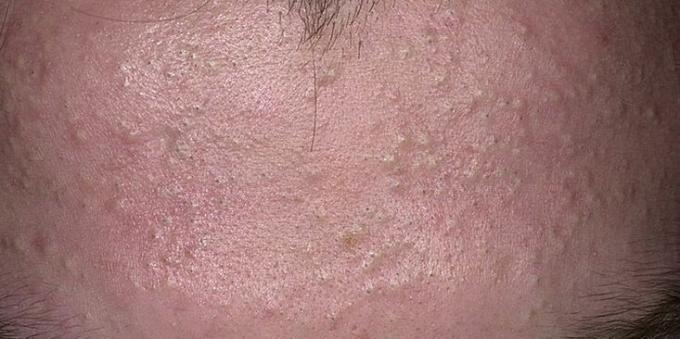 Como se livrar da acne: comedões fechados