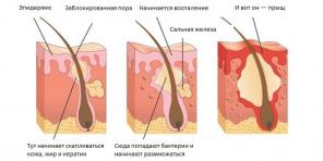 Como se livrar da Acne: O guia mais completo